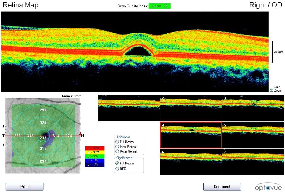 Retinal Pigment Epithelial Detachment (PED) 視網膜色素上皮脫離