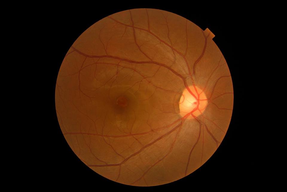 Retinal Pigment Epithelial Detachment (PED) 視網膜色素上皮脫離